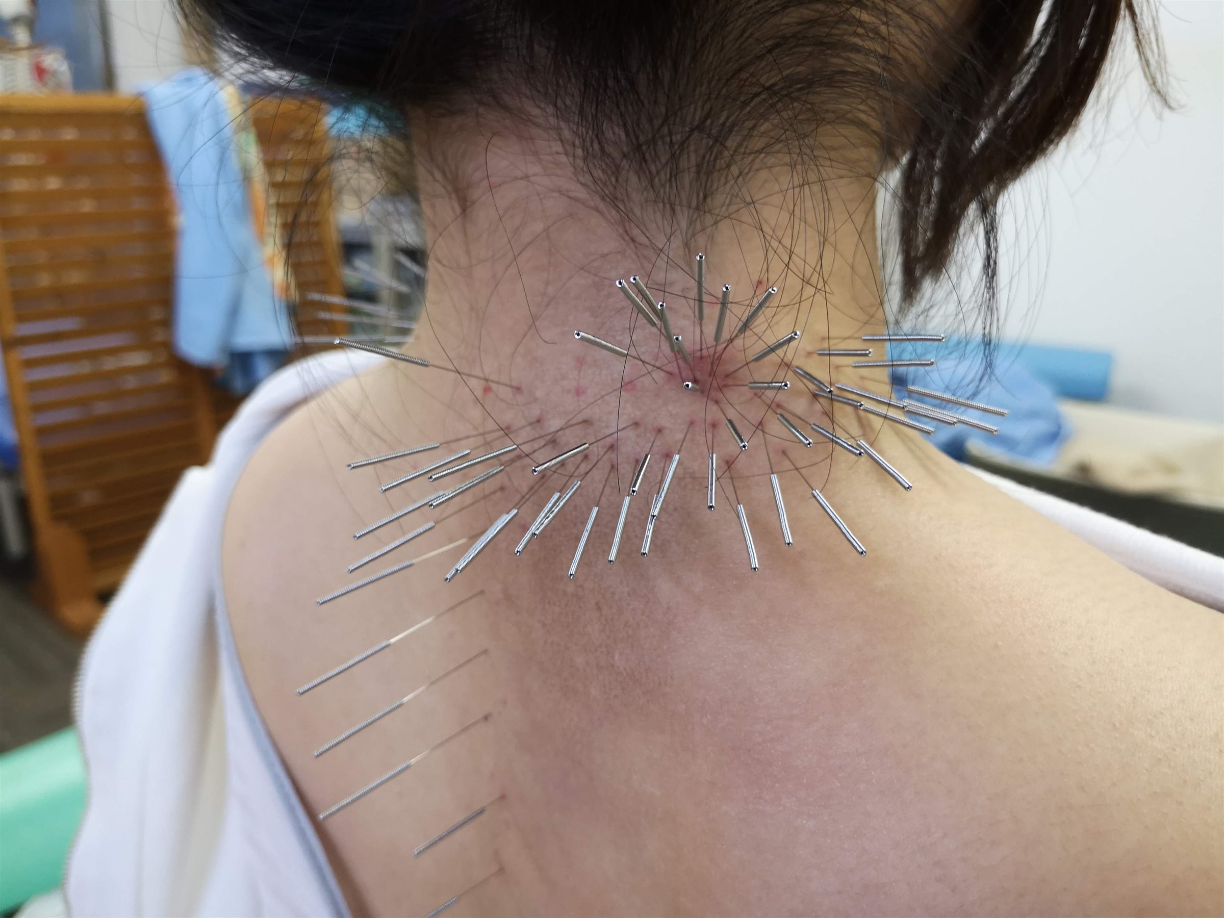 羊膜移植片の回収